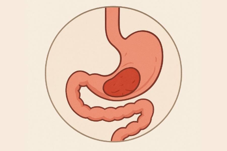 Hiatal Hernia