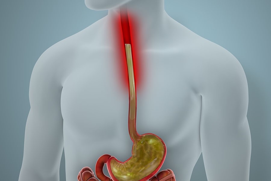 Esophageal Stricture (Achalasia)