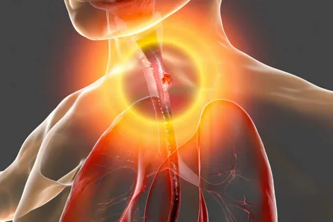 Esophageal Narrowing Resulting From Ingestion Of Caustic Substances