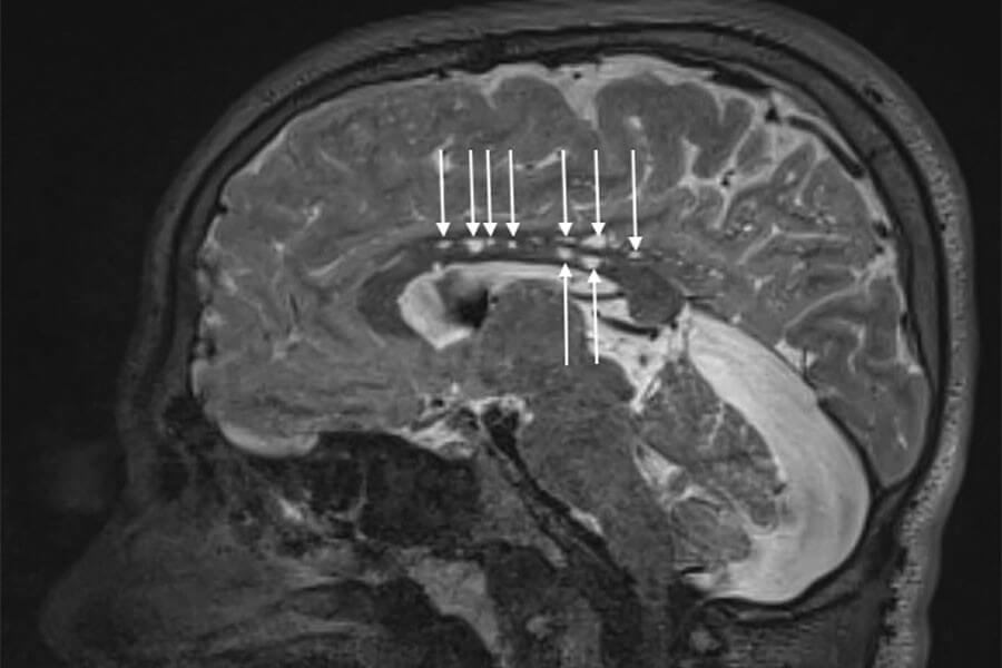 Mesenteric Artery Syndrome