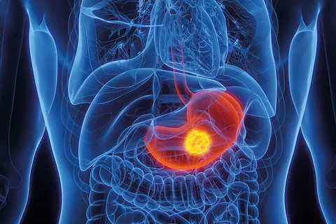 Benign Stomach Tumors