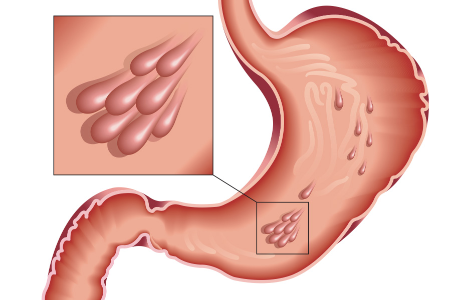 Malignant Stomach Tumors