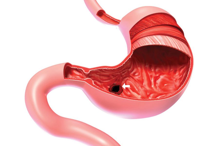 Esophagus Perforation