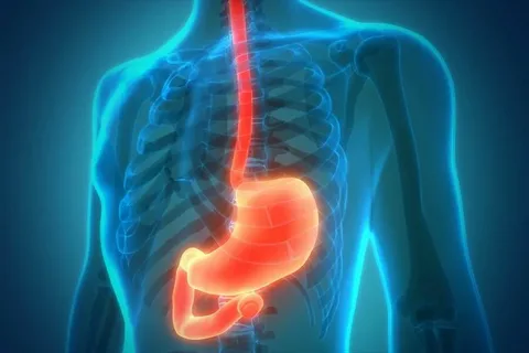 Gastroesophageal Reflux