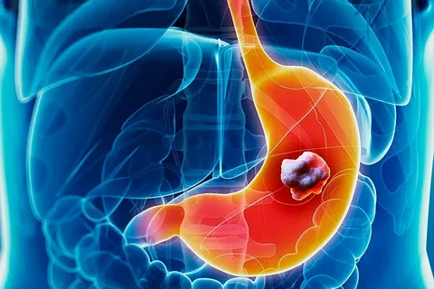 Esophageal Tumors (Benign/Malignant)